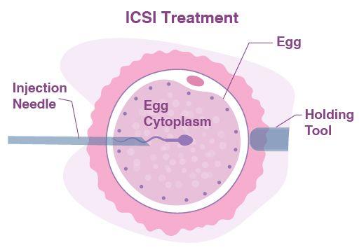 ICSI (Intracytoplasmic Sperm Injection) Treatment: Cost, Process ...