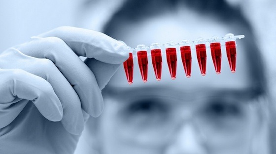 How to Diagnose PCOS/ PCOD?