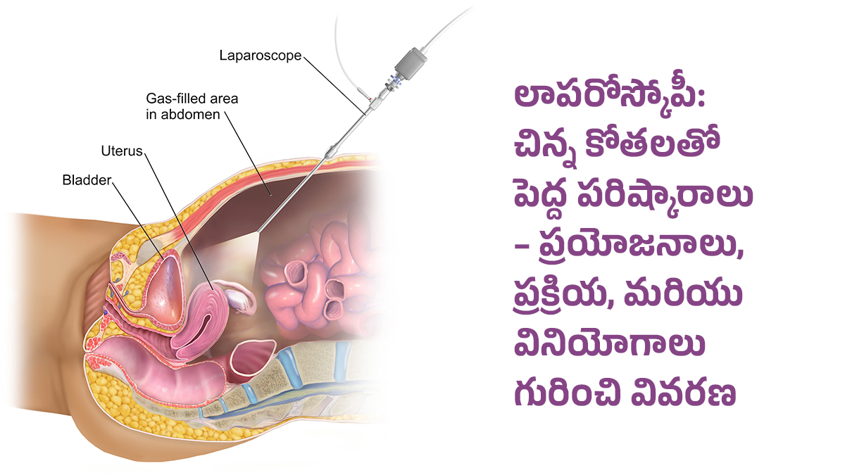 లాపరోస్కోపీ అంటే ఏమిటి? – ప్రయోజనాలు, విధానం మరియు రికవరీ సమయం