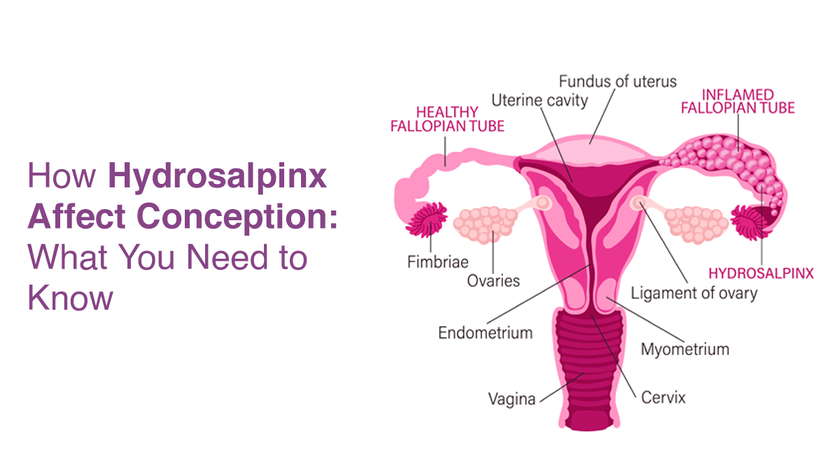 How Hydrosalpinx Affects Conception: What You Need to Know