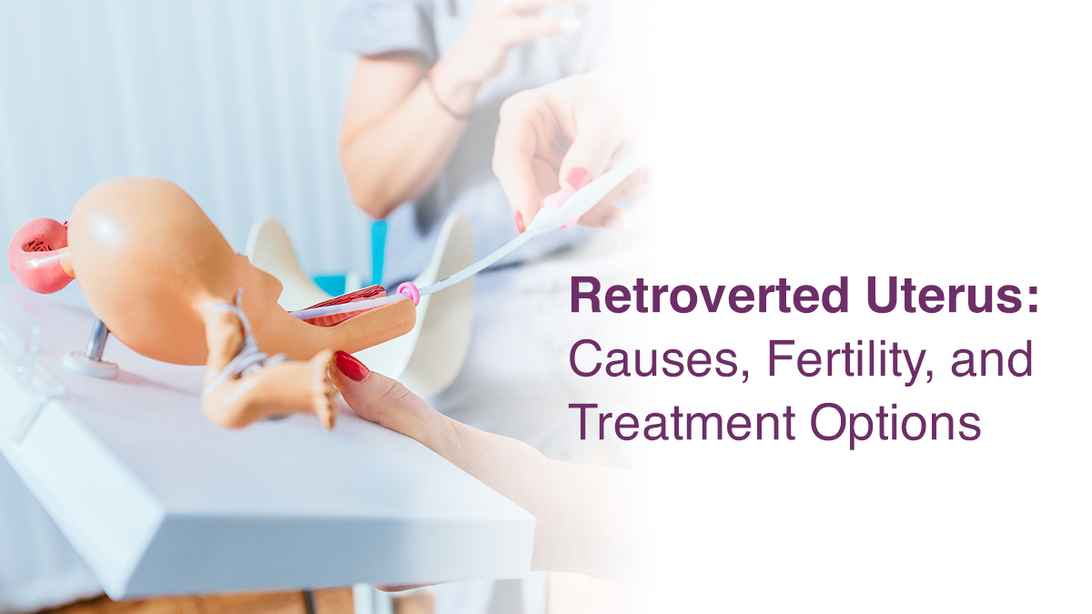 Retroverted Uterus: Causes, Fertility, and Treatment Options  