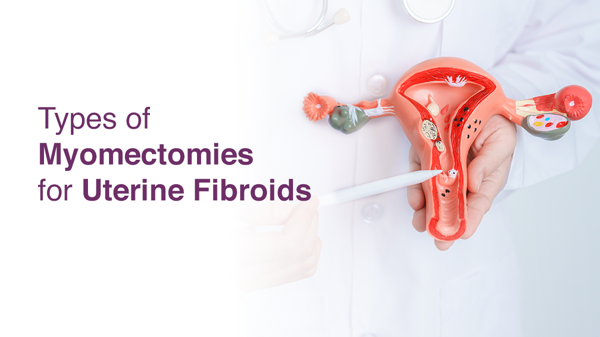 Types of Myomectomies for Uterine Fibroids