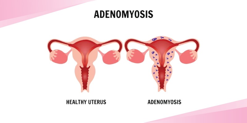 Adenomyosis – Everything you need to know
