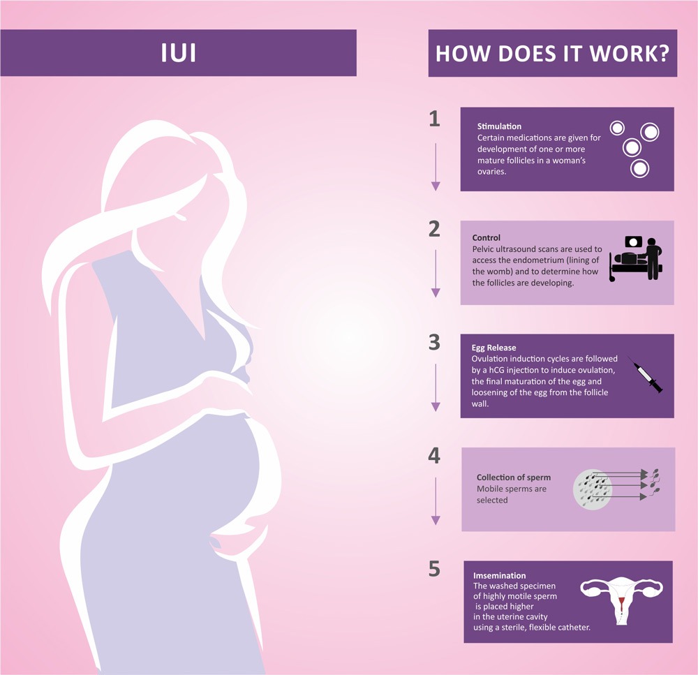 IUI