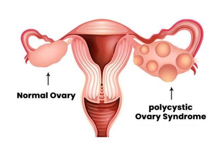 Can PCOS cause infertility?