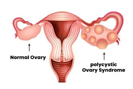 क्या पीसीओएस वन्ध्यत्व का कारण बन सकता है?
