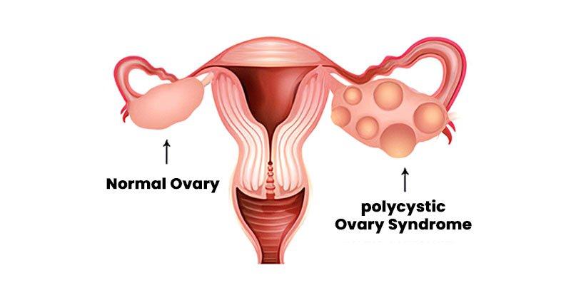 PCOS கருவளமின்மைக்கு காரணமாகுமா?