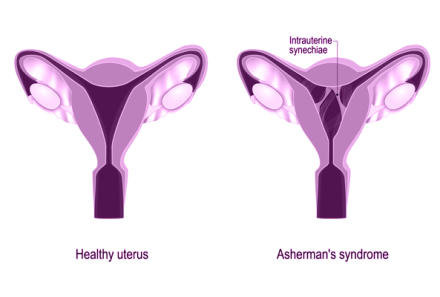 Intrauterine Adhesions and Infertility in Women