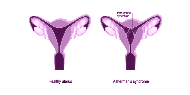 Intrauterine Adhesions and Infertility in Women