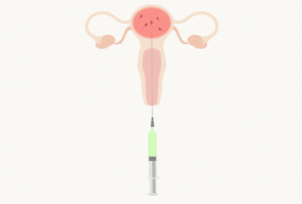 Is IUI (Intrauterine Insemination) the right choice for you?