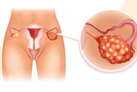 Ovarian Cancer Treatment – Fertility issues and preservation: Looking forward to the future