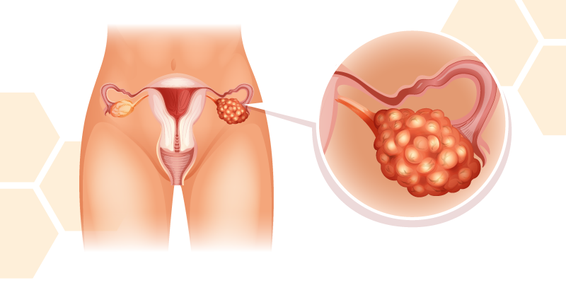 Ovarian Cancer Treatment – Fertility issues and preservation: Looking forward to the future