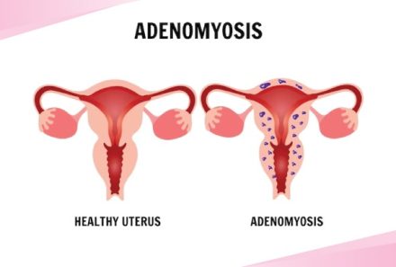 Adenomyosis – Everything you need to know