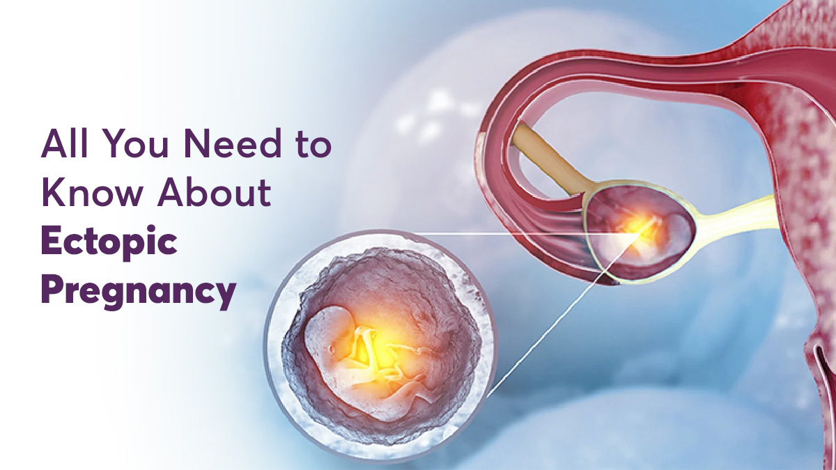 Ectopic Pregnancy