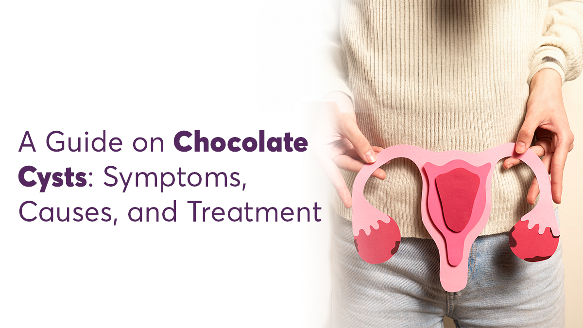 A Guide on Chocolate Cysts: Symptoms, Causes, and Treatment