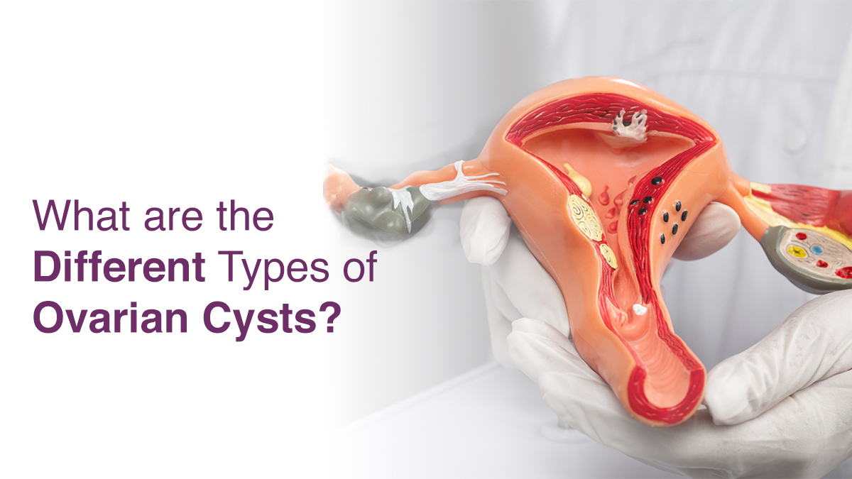 What are the Different Types of Ovarian Cysts?