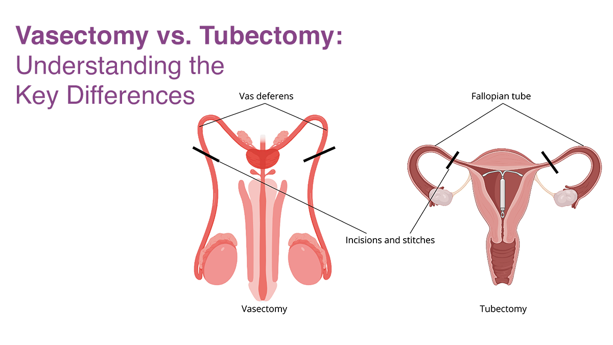 Vasectomy vs. Tubectomy: Understanding the Key Differences 