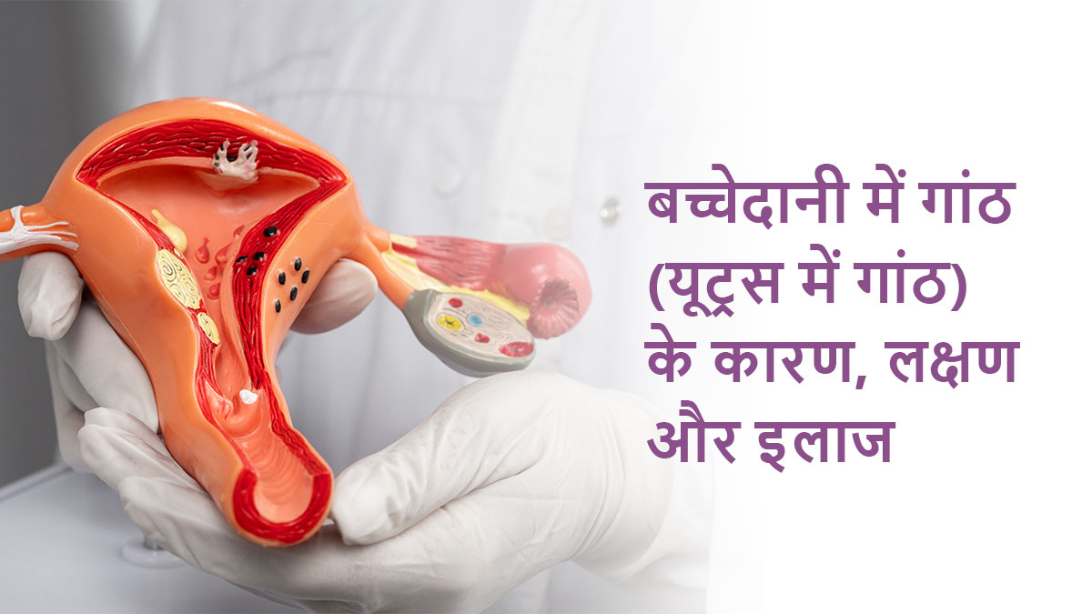बच्चेदानी में गांठ (यूट्रस में गांठ) के कारण, लक्षण और इलाज