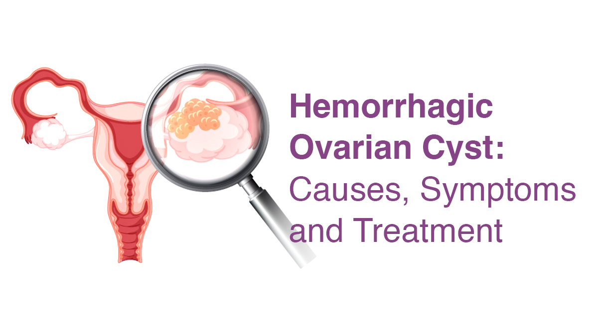 Hemorrhagic Ovarian Cyst: Causes, Symptoms, and Treatment